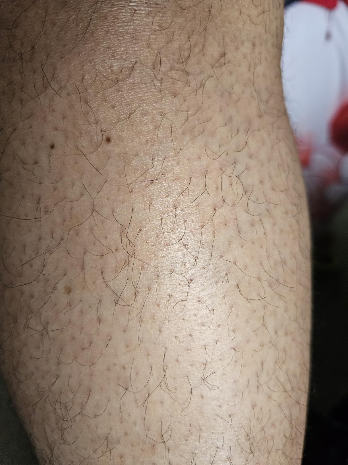 Ulike Laser Hair Removal Device Air 10 IPL for Women and Men, Ice Cool and Permanent Hair Reduction, Dual Lights, Skin Sensor & USHR Mode customer photo 2